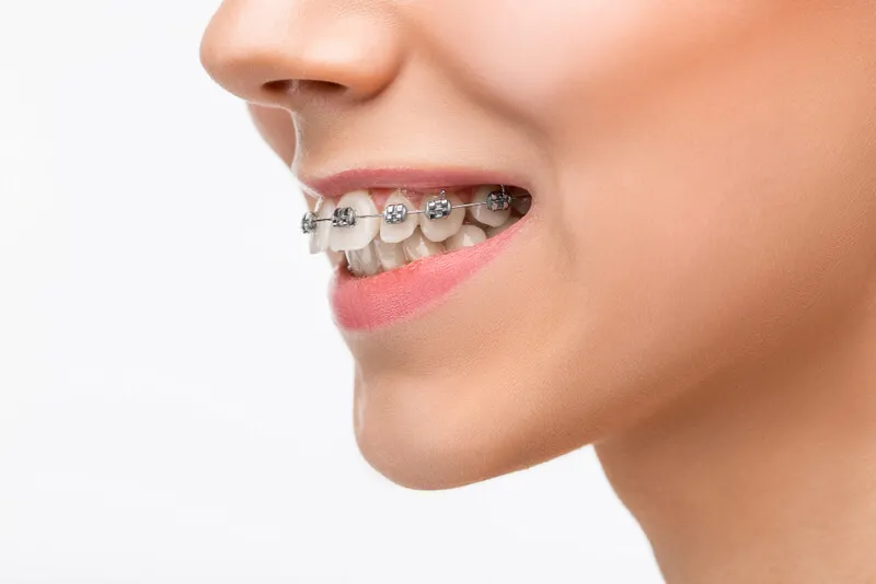 Visão lateral de uma boca sorrindo. É possível ver os dentes com aparelho ortodôntico fixo.