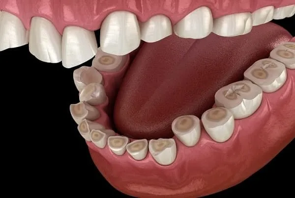 Arcada com erosão dentária afetando todos os dentes