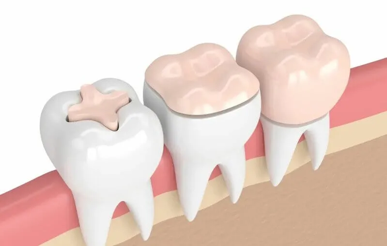 Desenho de três dentes com restaurações dentárias