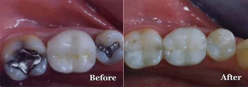 Imagem mostrando o antes e depois de uma restauração dentária com aplicação de resina
