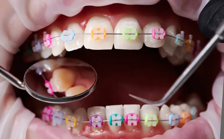 borrachas coloridas nos aparelhos ortodonticos