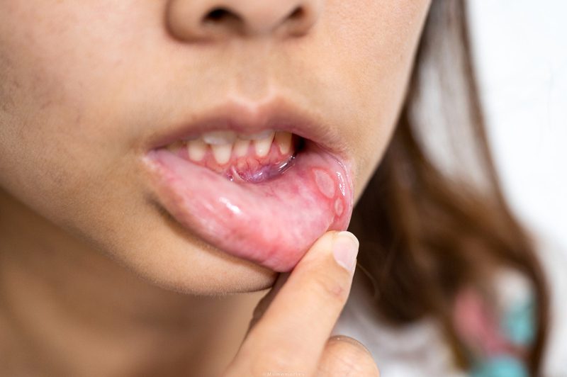 Causas da ferida na boca e língua
