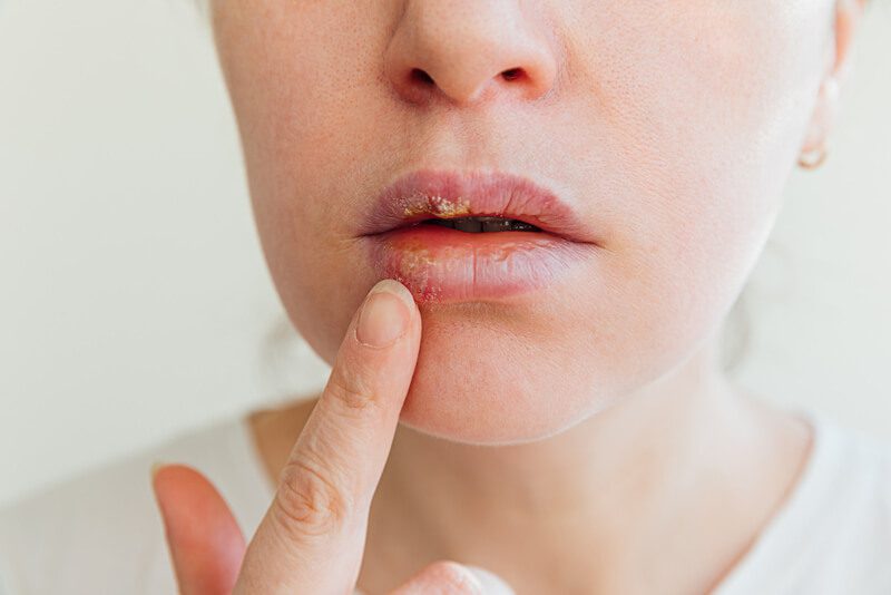 Causas da inflamação dos lábios