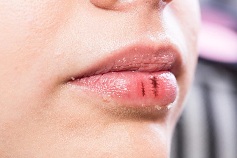 Sintomas da inflamação dos lábios