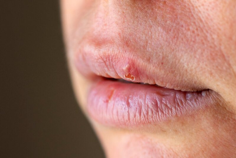 O que causa a espinha na boca