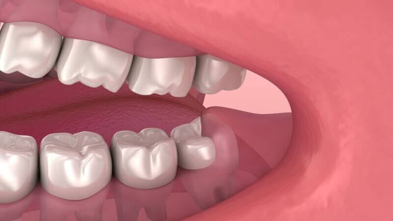 O Papel dos Dentes Molares na Saúde Bucal