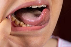 Bolinhas na boca O que pode ser o que fazer e 9 causas comuns
