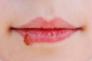 Herpes labial O que é quais os sintomas e tratamentos